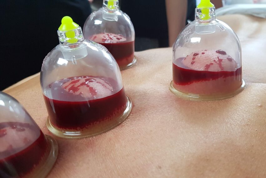 تصویری از کمر یک بیمار که دارد باکش خیس میکند